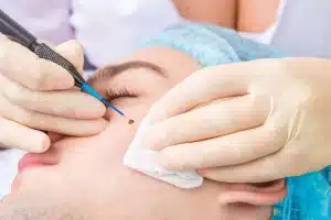 Unwanted Marks: Options for Mole and Scar Removal