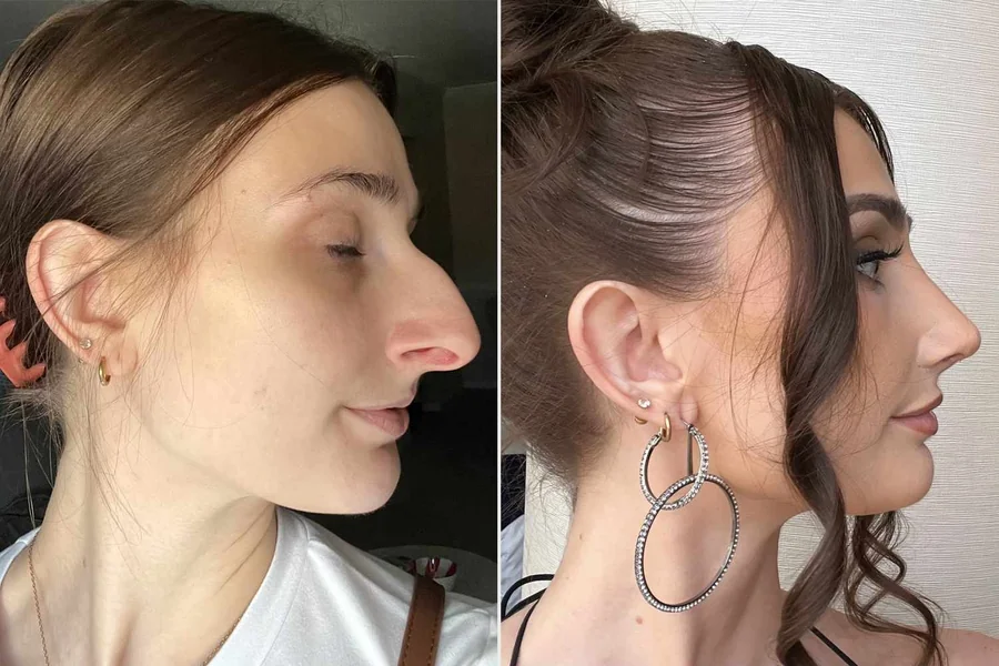 Rhinoplasty