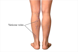 Why Varicose Veins Occur and How to Recognize and Treat Them