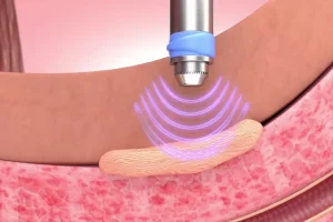 Gainswave Therapy: The Revolutionary Erectile Dysfunction Treatment Without Pills