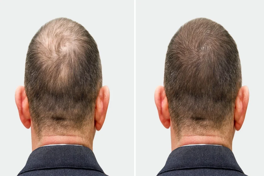 Hair Replacement