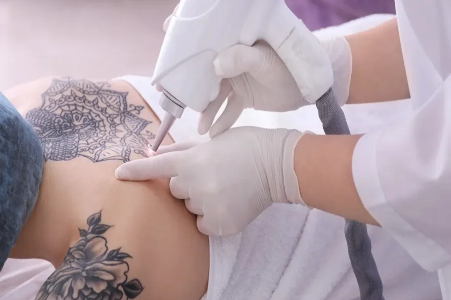Tattoo Removal