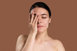 Fungal Acne vs Hormonal Acne: Let’s Clear the Confusion Once and for All 