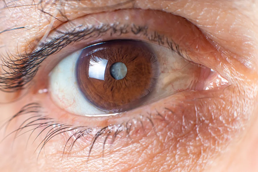 Cataract Symptoms Early Signs of Motiyabind You Should Never Ignore