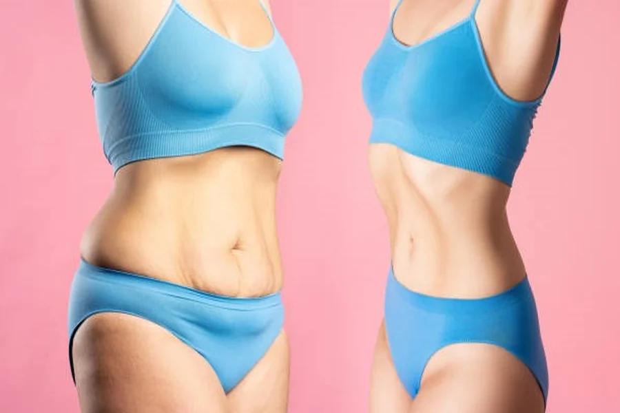 Liposuction