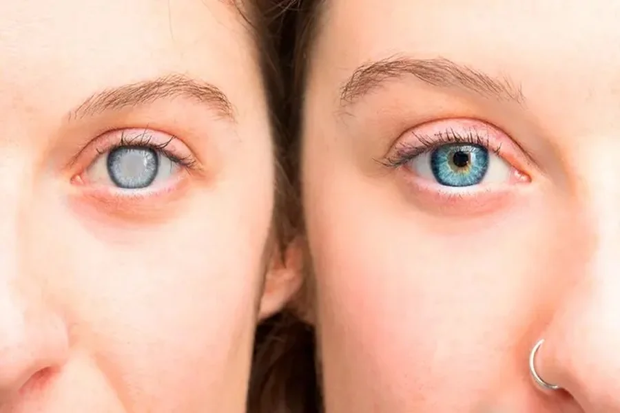 Eye Doctor in Kansas City for Cataracts What to Expect From Diagnosis to Surgery