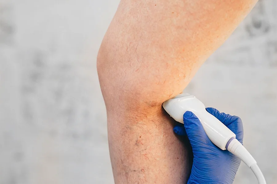 Top Vein Treatments For Varicose and Spider Veins