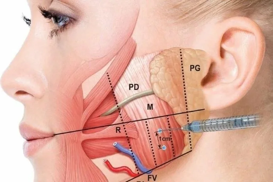 Can Botox Help With TMJ Jaw Pain And Clenching