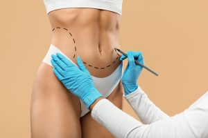 Preparation of Liposculpture Treatment and Recovery