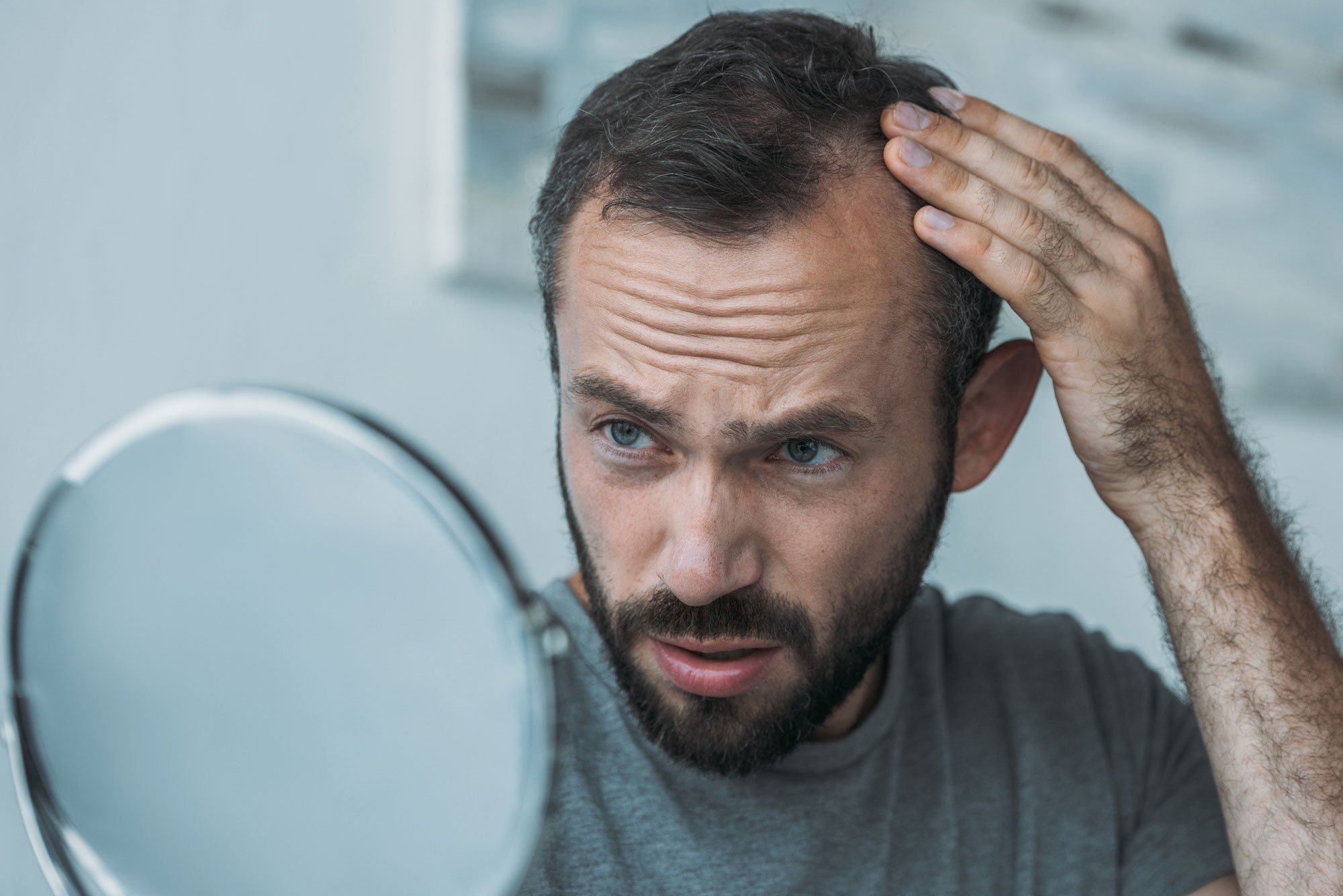 Male Pattern Baldness