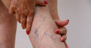 Signs That Varicose Vein Treatment May Be Necessary