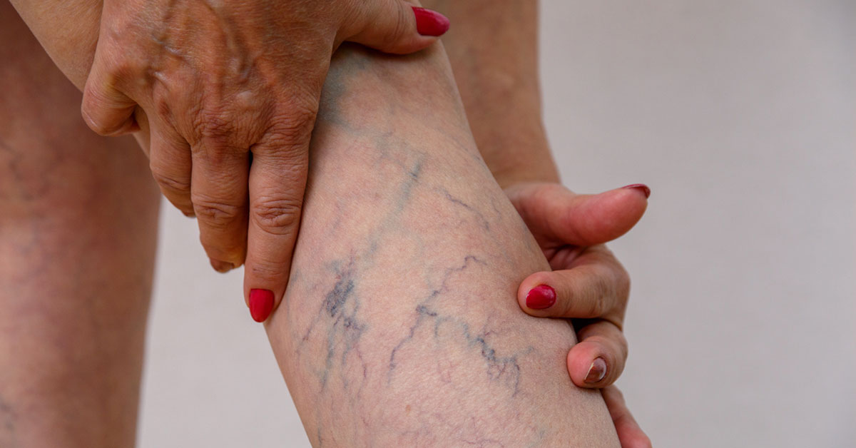 Vein Treatment