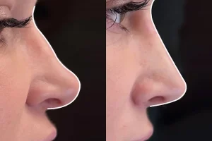 The Nose Job Conversation Nobody in Wellness Is Having (But Should Be)