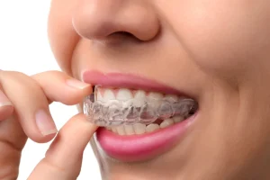 How Long Does It Take for Clear Aligners to Work?