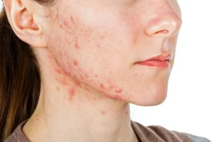 Adult Acne: Why Your Skin Is Breaking Out After 30 and How to Handle It