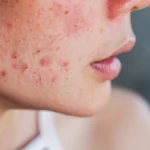 Acne Gel: Dermatologist Tips to Speed Up Blemish Healing 