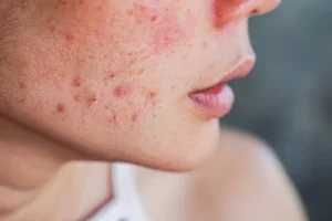 Acne Gel: Dermatologist Tips to Speed Up Blemish Healing 